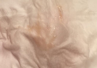 懷孕褐色分泌物是男孩 懷孕初期有褐色分泌物流出是男孩嗎