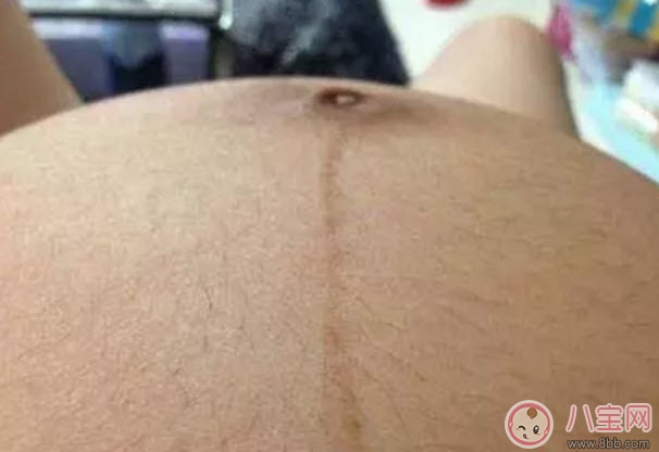 孕婦懷孕后身體哪個(gè)部位容易變黑呢 孕婦變黑對(duì)寶寶會(huì)有什么影響嗎