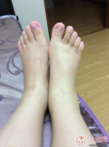 了解好懷孕水腫原因 懷孕水腫很快消