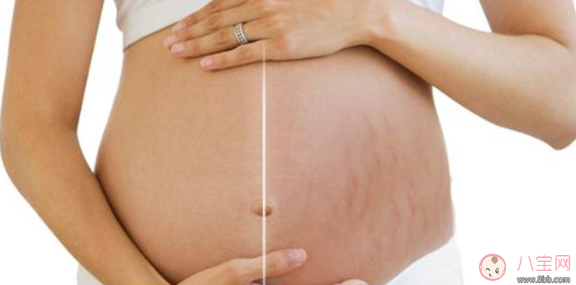 這些人居然天生不長妊娠紋 不長妊娠紋的奧秘是什么 這些人居然天生不長妊娠紋 不長妊娠紋的奧秘是什么