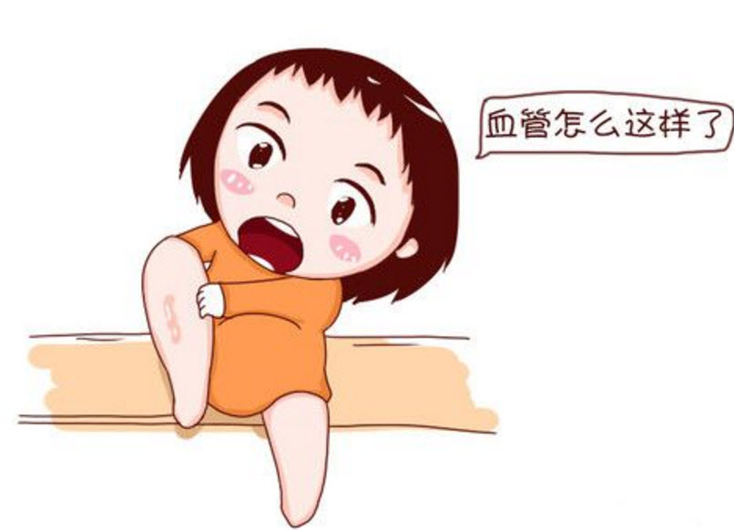 孕婦靜脈曲張是怎么回事 孕婦靜脈曲張?jiān)趺淳徑? alt=