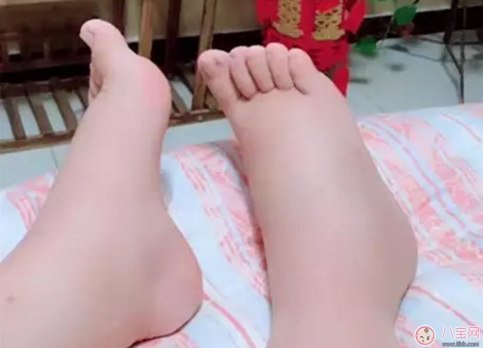 孕晚期水腫怎么緩解 孕婦孕晚期浮腫是什么原因