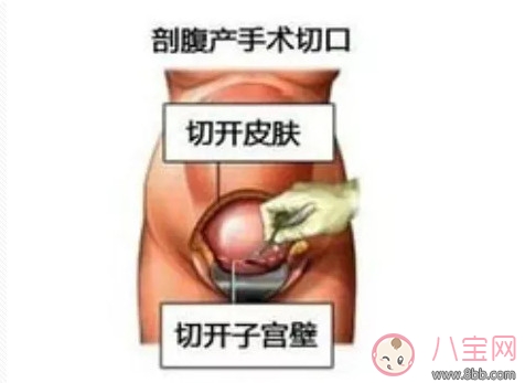 剖腹產(chǎn)孕婦會不會感到疼痛 剖腹產(chǎn)橫剖還是縱剖。