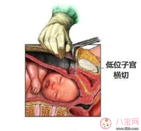 剖腹產(chǎn)孕婦會不會感到疼痛 剖腹產(chǎn)橫剖還是縱剖。