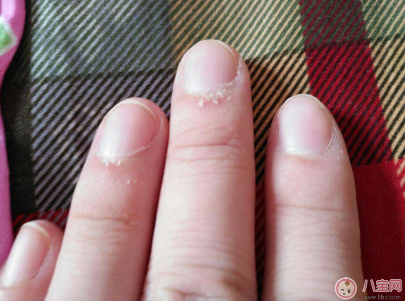 手上長這個千萬不要撕 倒刺的正確處理方法