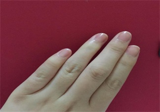 手上長(zhǎng)這個(gè)千萬(wàn)不要撕 倒刺的正確處理方法