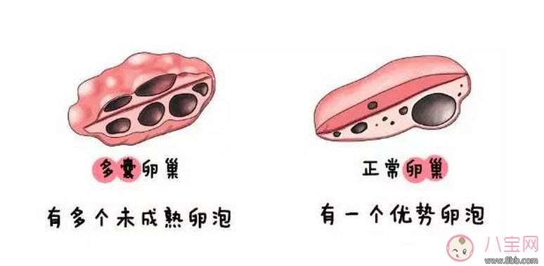 昆凌三胎計(jì)劃，昆凌多囊性卵巢癥候群是什么病
