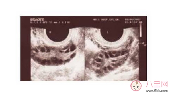 昆凌三胎計(jì)劃，昆凌多囊性卵巢癥候群是什么病