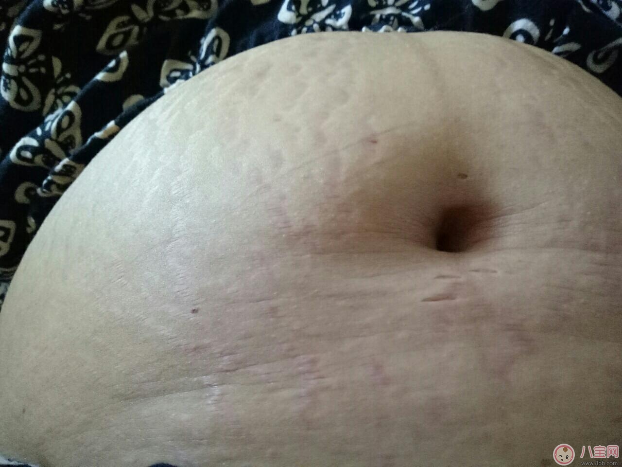 孕辰紋怎么消除 這些產(chǎn)品防止孕辰紋產(chǎn)生和消除孕辰紋