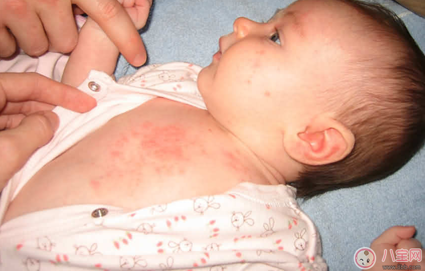 寶寶痱子總不消 用用這個(gè)準(zhǔn)會(huì)好