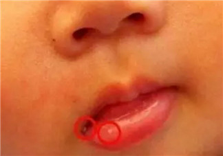 秋天怎么預(yù)防寶寶口角炎 寶寶口角炎的食療方法