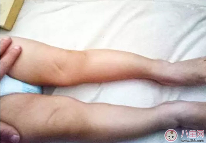 嬰兒為什么是青蛙腿 寶寶青蛙腿用不用綁腿 嬰兒為什么是青蛙腿 寶寶青蛙腿用不用綁腿