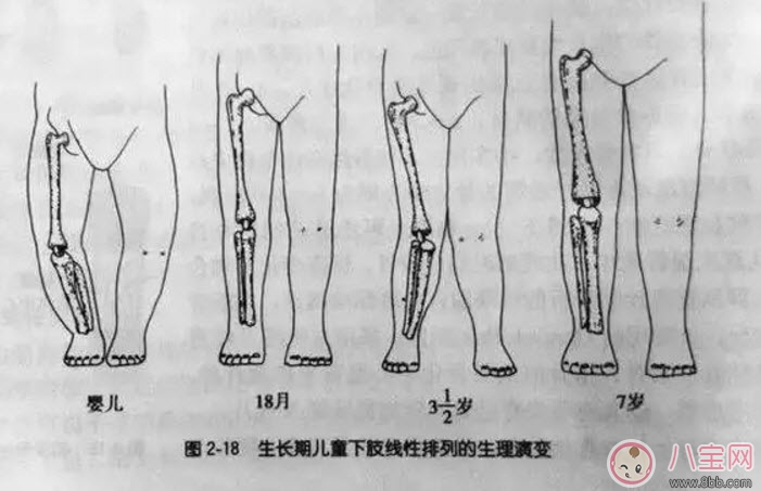 嬰兒為什么是青蛙腿 寶寶青蛙腿用不用綁腿 嬰兒為什么是青蛙腿 寶寶青蛙腿用不用綁腿