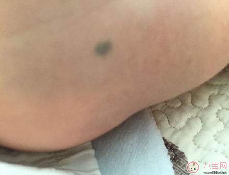 嬰兒屁股下面有胎記有什么含義 新生兒寶寶屁股下面有胎記好不好 嬰兒屁股下面有胎記有什么含義 新生兒寶寶屁股下面有胎記好不好