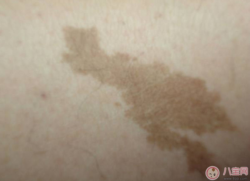 嬰兒屁股下面有胎記有什么含義 新生兒寶寶屁股下面有胎記好不好 嬰兒屁股下面有胎記有什么含義 新生兒寶寶屁股下面有胎記好不好