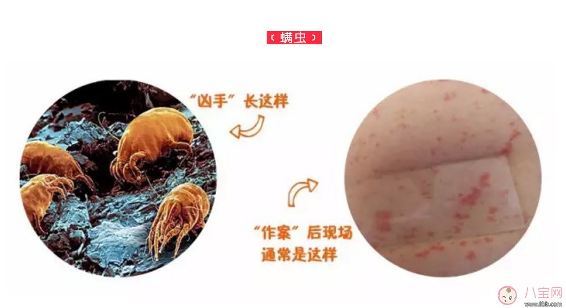 寶寶螨蟲過敏怎么辦，寶寶被螨蟲咬和蚊子咬癥狀對比圖片區(qū)別