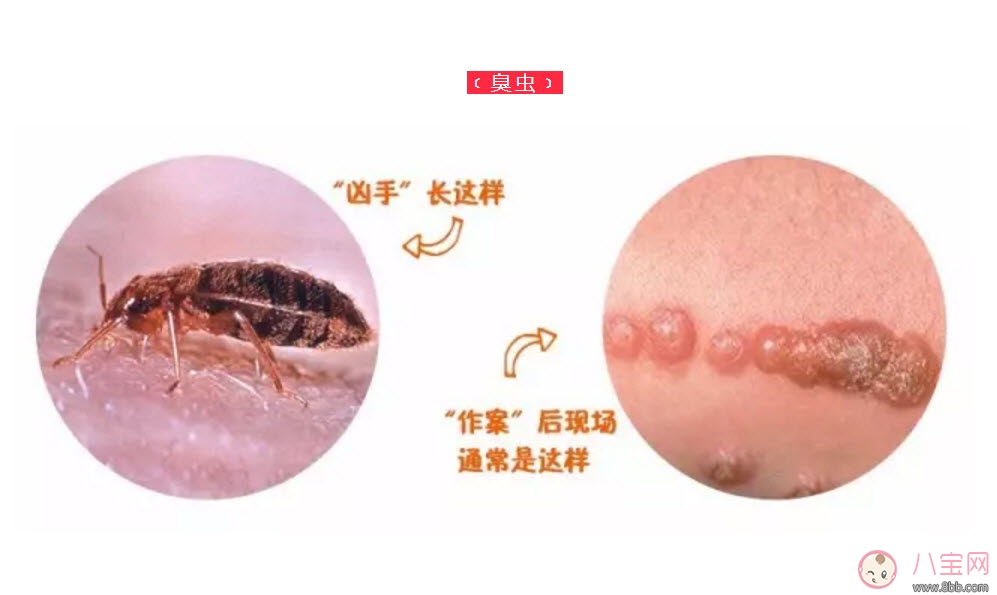 寶寶被臭蟲咬了癥狀圖片 寶寶被臭蟲咬和蚊子咬癥狀對(duì)比圖片區(qū)別
