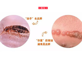 寶寶被臭蟲咬了癥狀圖片 寶寶被臭蟲咬和蚊子咬癥狀對比圖片區(qū)別