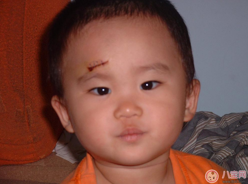 孩子受傷怎么做不留疤 傷口不留疤處理方法 孩子受傷怎么做不留疤 傷口不留疤處理方法