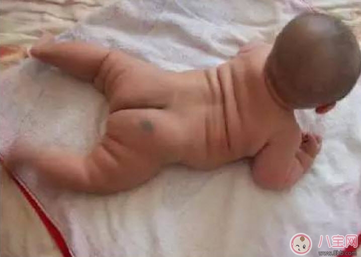 寶寶胎記多大治療最好 寶寶治療胎記的最佳時間 寶寶胎記多大治療最好 寶寶治療胎記的最佳時間