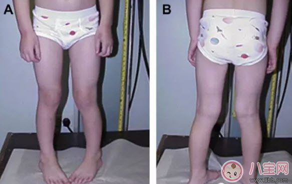 寶寶走路內(nèi)八字怎么辦 寶寶走路內(nèi)八字的原因有哪些 寶寶走路內(nèi)八字怎么辦 寶寶走路內(nèi)八字的原因有哪些