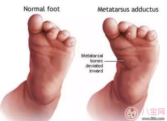 寶寶走路內(nèi)八字怎么辦 寶寶走路內(nèi)八字的原因有哪些 寶寶走路內(nèi)八字怎么辦 寶寶走路內(nèi)八字的原因有哪些