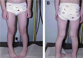 寶寶走路內八字怎么辦 寶寶走路內八字的原因有哪些