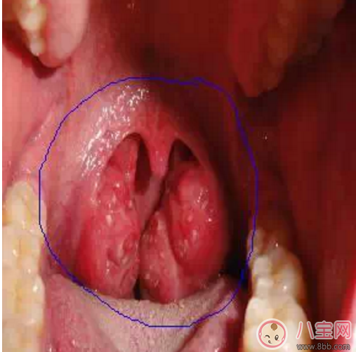 寶寶扁桃體炎表現(xiàn) 如何預防小兒扁桃體炎 寶寶扁桃體炎表現(xiàn) 如何預防小兒扁桃體炎