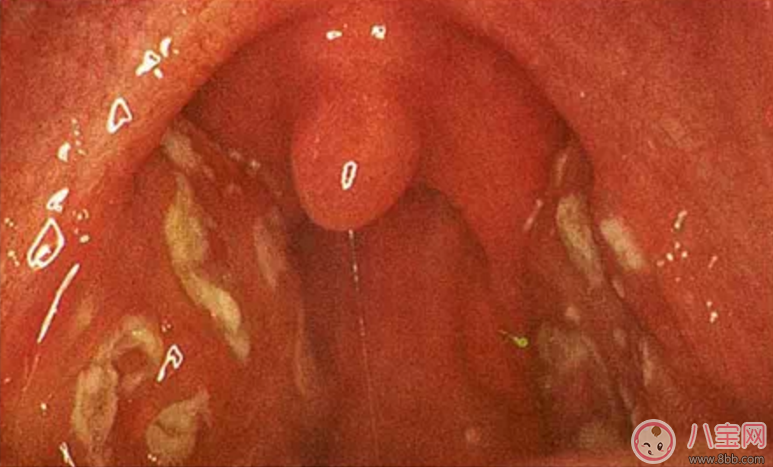 寶寶扁桃體炎表現(xiàn) 如何預防小兒扁桃體炎 寶寶扁桃體炎表現(xiàn) 如何預防小兒扁桃體炎