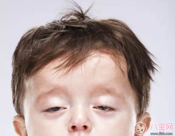 嬰兒鬼臉綜合癥癥狀圖有哪些 過(guò)量補(bǔ)鈣造成鬼臉綜合癥的危害是什么