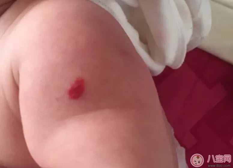 新生兒紅色胎記和血管瘤的對(duì)比方法 寶寶胎記和血管瘤的區(qū)別