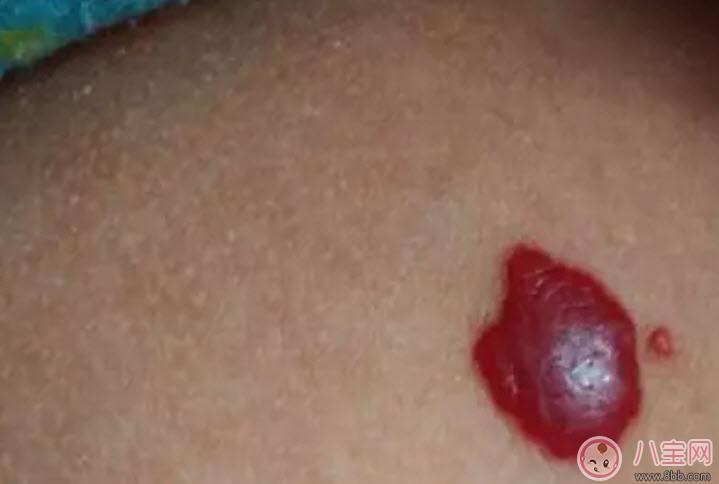 新生兒紅色胎記和血管瘤的對(duì)比方法 寶寶胎記和血管瘤的區(qū)別