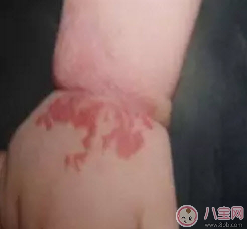 新生兒紅色胎記和血管瘤的對(duì)比方法 寶寶胎記和血管瘤的區(qū)別
