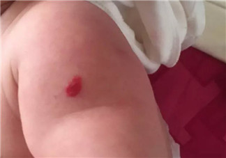 新生兒紅色胎記和血管瘤的對(duì)比方法 寶寶胎記和血管瘤的區(qū)別