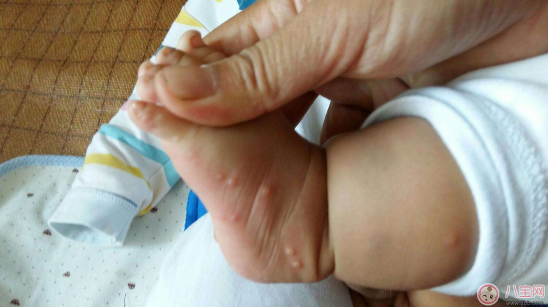 孩子長水痘這些東西千萬遠離 孩子水痘好得快方法 孩子長水痘這些東西千萬遠離 孩子水痘好得快方法