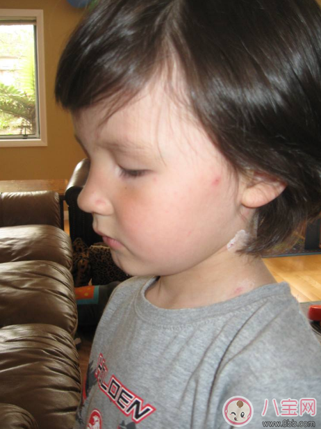 孩子長水痘這些東西千萬遠離 孩子水痘好得快方法 孩子長水痘這些東西千萬遠離 孩子水痘好得快方法