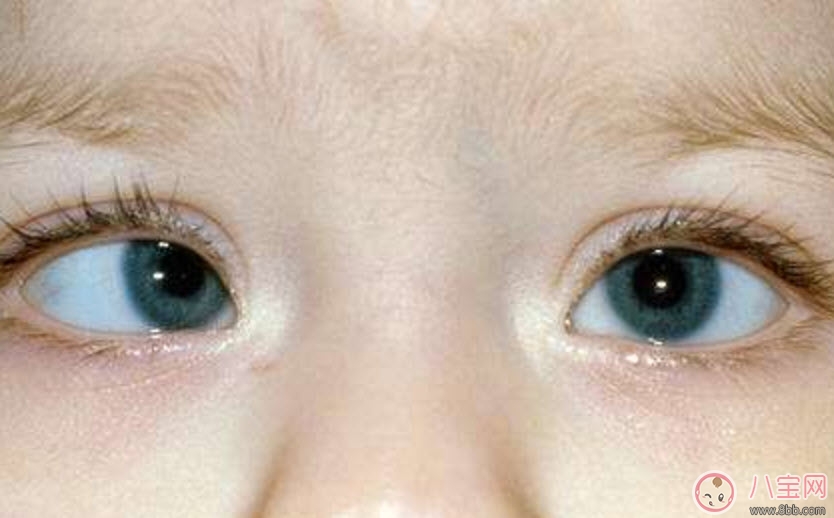 寶寶斜視手術(shù)風(fēng)險(xiǎn)大嗎 寶寶斜視一定要做手術(shù)嗎 寶寶斜視手術(shù)風(fēng)險(xiǎn)大嗎 寶寶斜視一定要做手術(shù)嗎