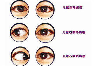 寶寶斜視手術(shù)風險大嗎 寶寶斜視一定要做手術(shù)嗎