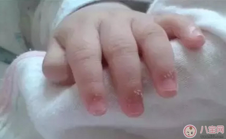 寶寶手上長(zhǎng)肉刺是因?yàn)槿狈I(yíng)養(yǎng)嗎 寶寶手指上長(zhǎng)倒刺是什么原因