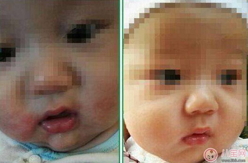 寶寶嘴角邊長濕疹怎么辦 寶寶嘴角濕疹是什么原因 寶寶嘴角邊長濕疹怎么辦 寶寶嘴角濕疹是什么原因
