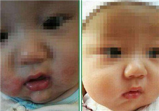 寶寶嘴角邊長濕疹怎么辦 寶寶嘴角濕疹是什么原因