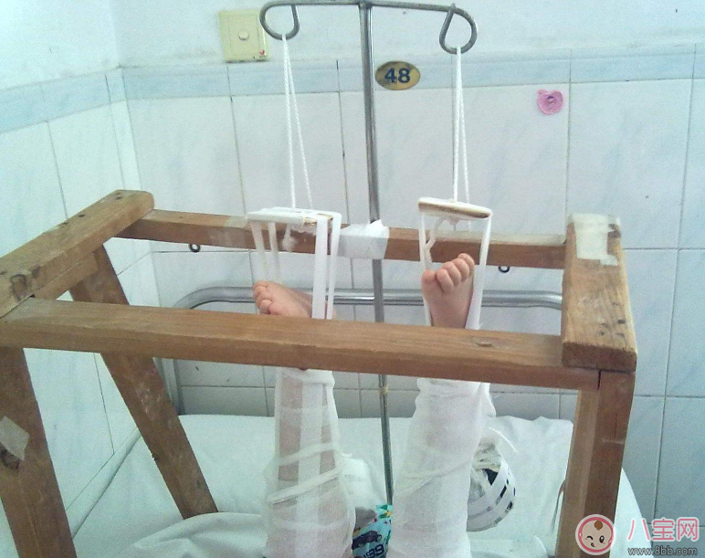 孩子總是容易骨折 孩子骨折后怎么處理 孩子總是容易骨折 孩子骨折后怎么處理