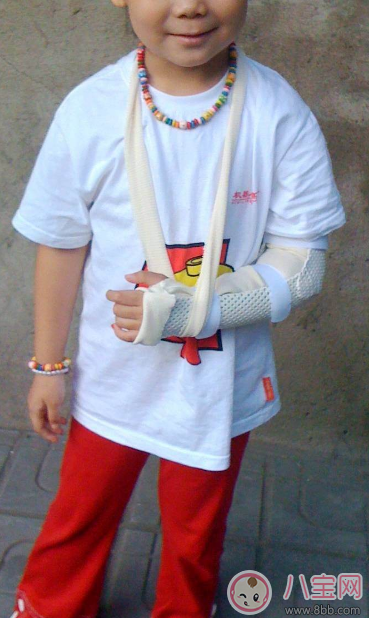 孩子總是容易骨折 孩子骨折后怎么處理 孩子總是容易骨折 孩子骨折后怎么處理