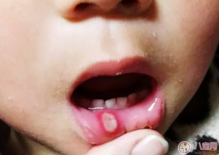 寶寶口腔潰瘍?cè)趺崔k 寶寶口腔潰瘍吃什么好的快