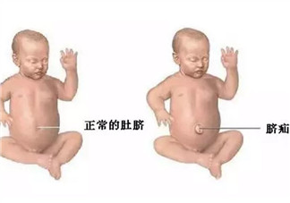 臍疝對(duì)寶寶有什么影響 寶寶臍疝是什么原因引起的