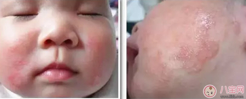 寶寶痱子和濕疹的區(qū)別 寶寶濕疹和痱子最大的不同是什么 寶寶痱子和濕疹的區(qū)別 寶寶濕疹和痱子最大的不同是什么