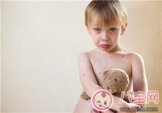 寶寶長水痘的原因 如何發(fā)現(xiàn)寶寶長水痘