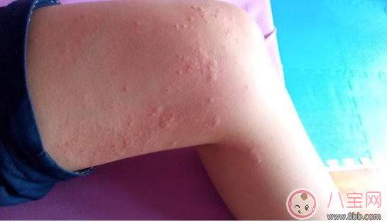 孩子玫瑰疹怎么護(hù)理 細(xì)心護(hù)理好得快 孩子玫瑰疹怎么護(hù)理 細(xì)心護(hù)理好得快