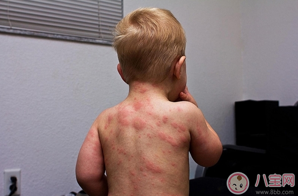 孩子玫瑰疹怎么護(hù)理 細(xì)心護(hù)理好得快 孩子玫瑰疹怎么護(hù)理 細(xì)心護(hù)理好得快