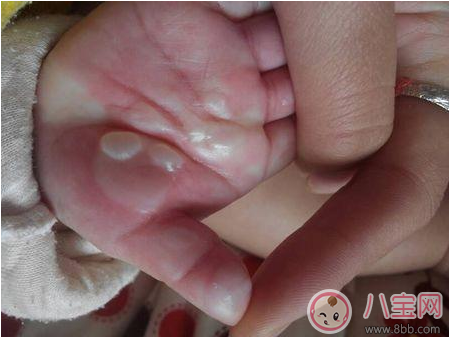 孩子燙傷后抹醬油有效嗎 這些偏方燙傷后千萬不要學(xué) 孩子燙傷后抹醬油有效嗎 這些偏方燙傷后千萬不要學(xué)